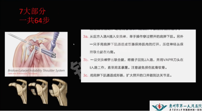 肩关节脱位“新认识”