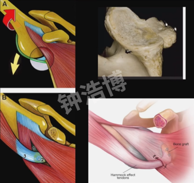肩关节脱位“新认识”