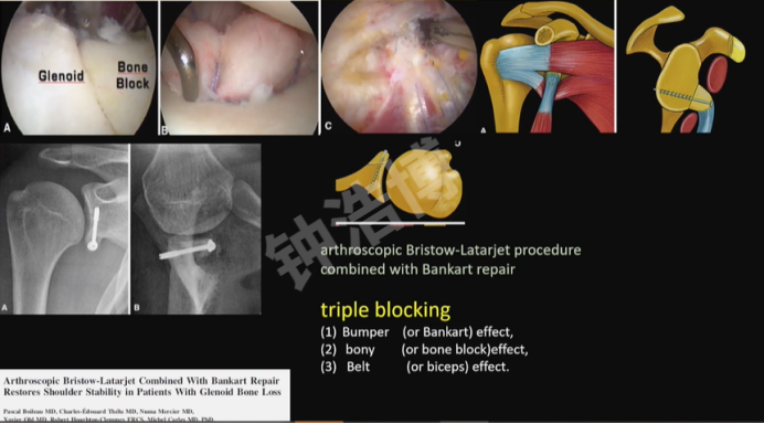 肩关节脱位“新认识”