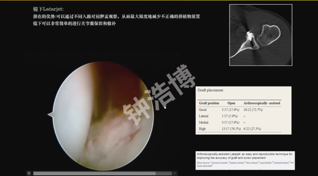 肩关节脱位“新认识”