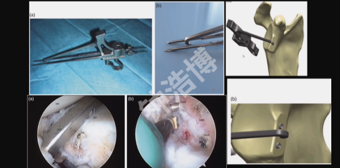 肩关节脱位“新认识”