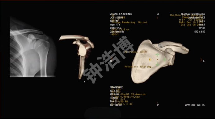 肩关节脱位“新认识”