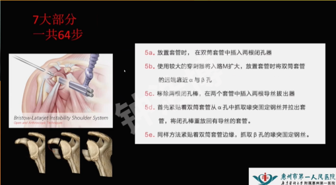 肩关节脱位“新认识”