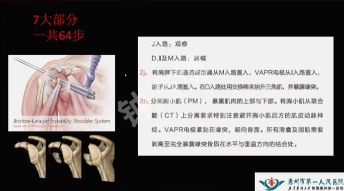 肩关节脱位“新认识”