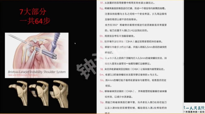 肩关节脱位“新认识”