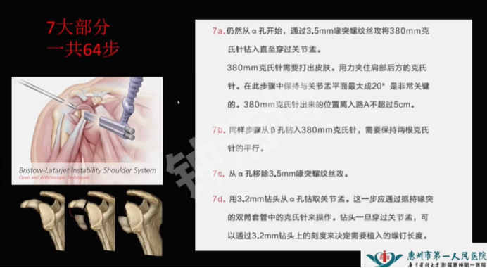 肩关节脱位“新认识”