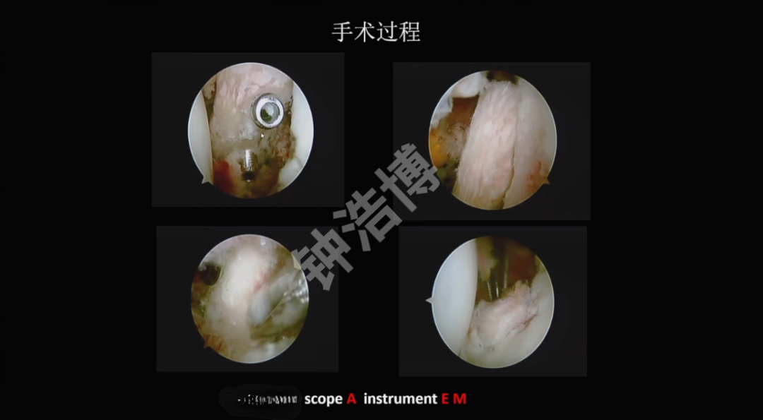 肩关节脱位“新认识”