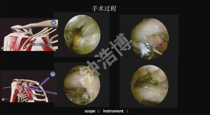 肩关节脱位“新认识”