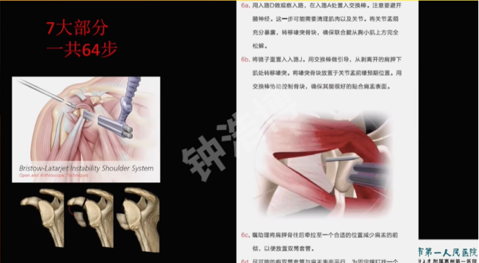 肩关节脱位“新认识”