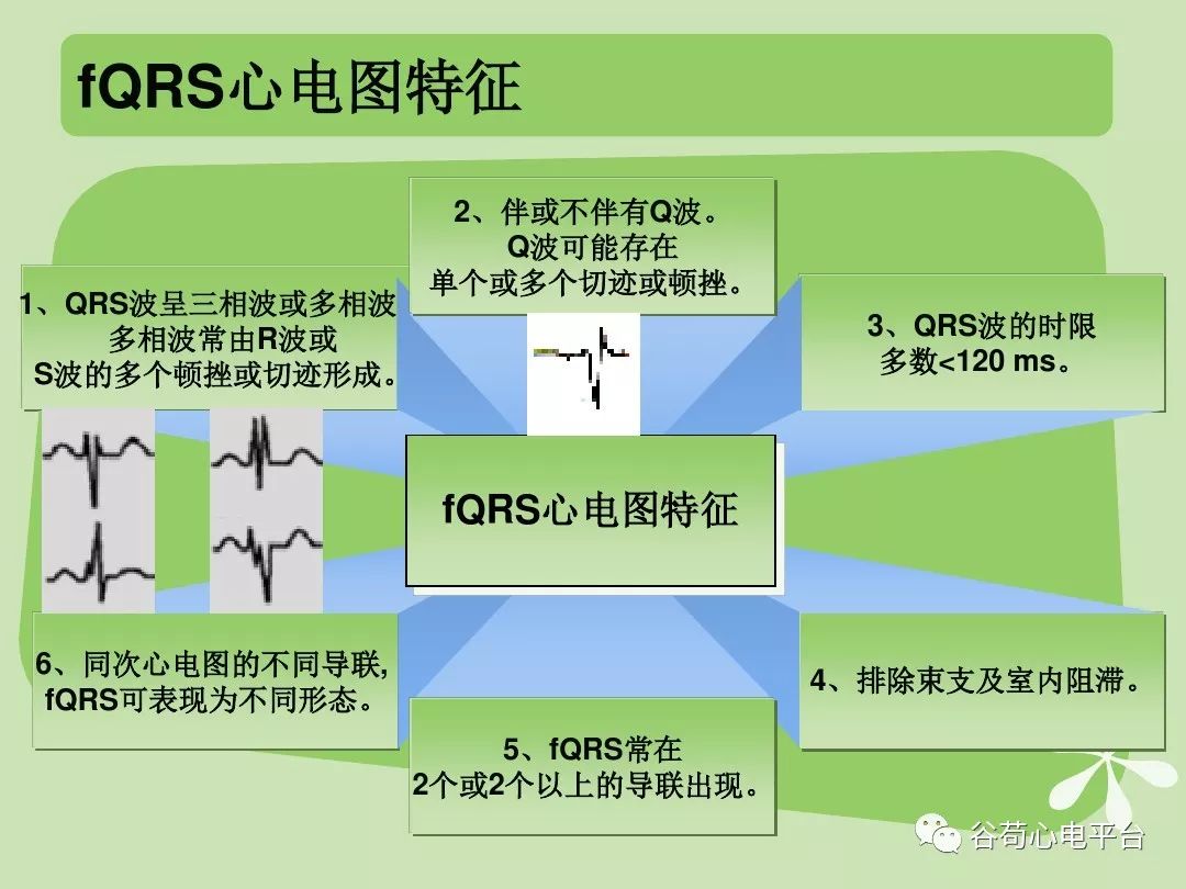 一个少见的心电图诊断名称：碎裂性QRS波