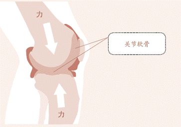 膝骨关节炎的“金字塔”三级疗法,每个都很重要!