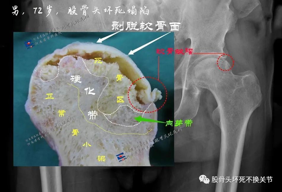 股骨头坏死如何选择治疗方案?