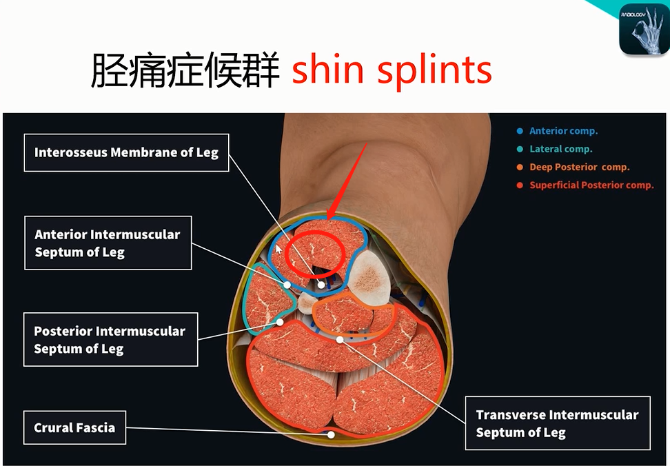 收藏！常见跑步性损伤影像表现总结！