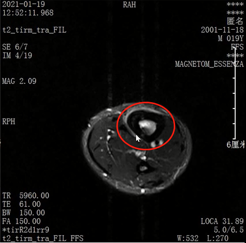 收藏！常见跑步性损伤影像表现总结！