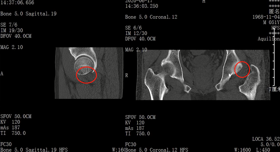 收藏！常见跑步性损伤影像表现总结！