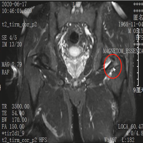 收藏！常见跑步性损伤影像表现总结！