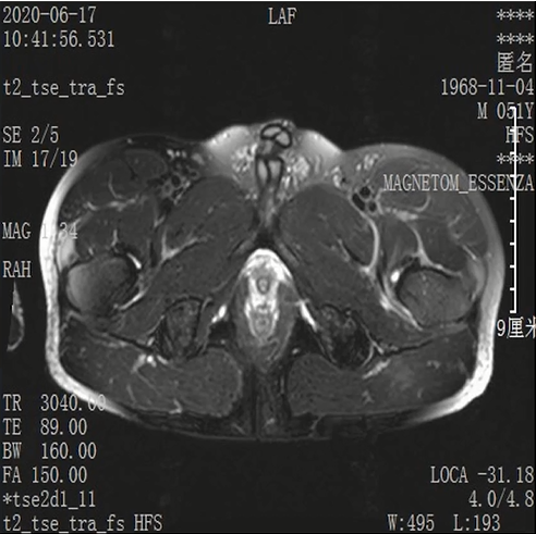 收藏！常见跑步性损伤影像表现总结！