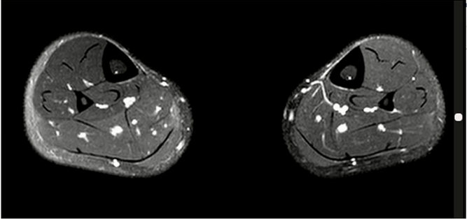 收藏！常见跑步性损伤影像表现总结！