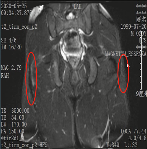收藏！常见跑步性损伤影像表现总结！