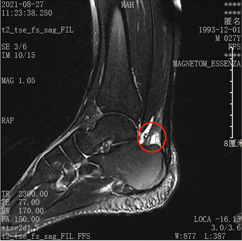 收藏！常见跑步性损伤影像表现总结！