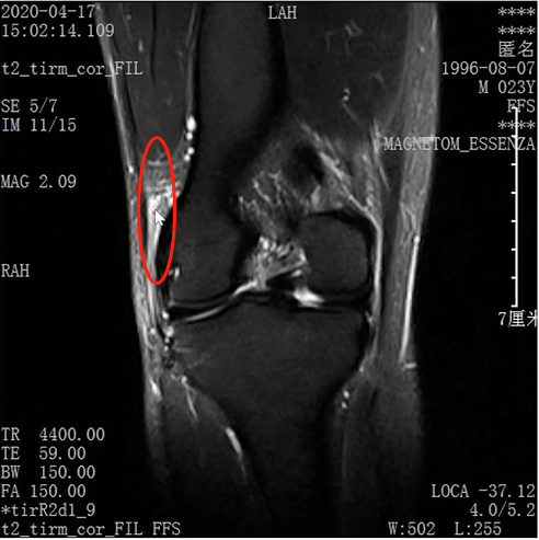 收藏！常见跑步性损伤影像表现总结！