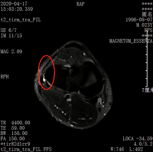 收藏！常见跑步性损伤影像表现总结！