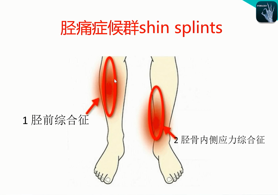 收藏！常见跑步性损伤影像表现总结！