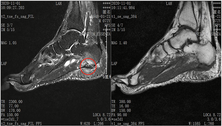 收藏！常见跑步性损伤影像表现总结！