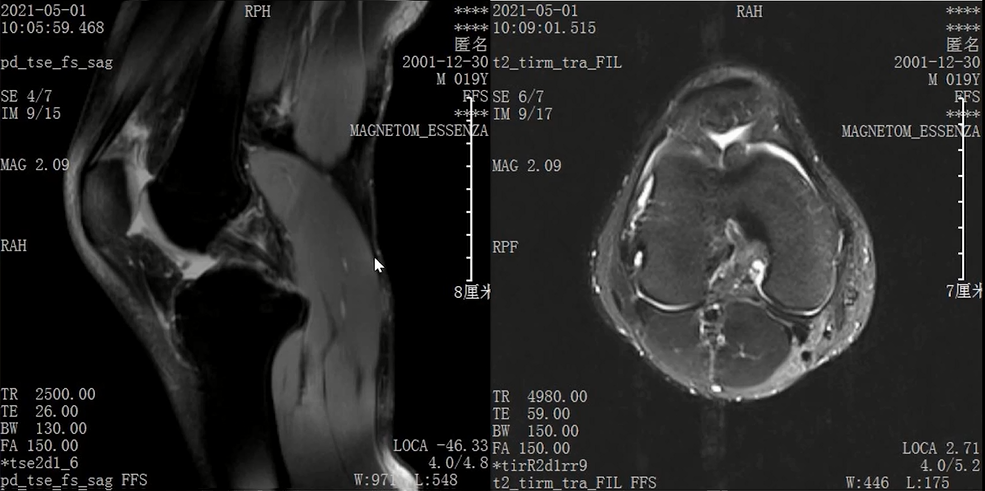 收藏！常见跑步性损伤影像表现总结！