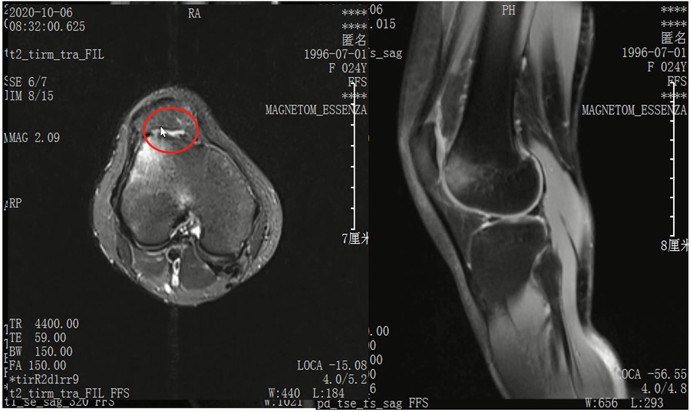 收藏！常见跑步性损伤影像表现总结！