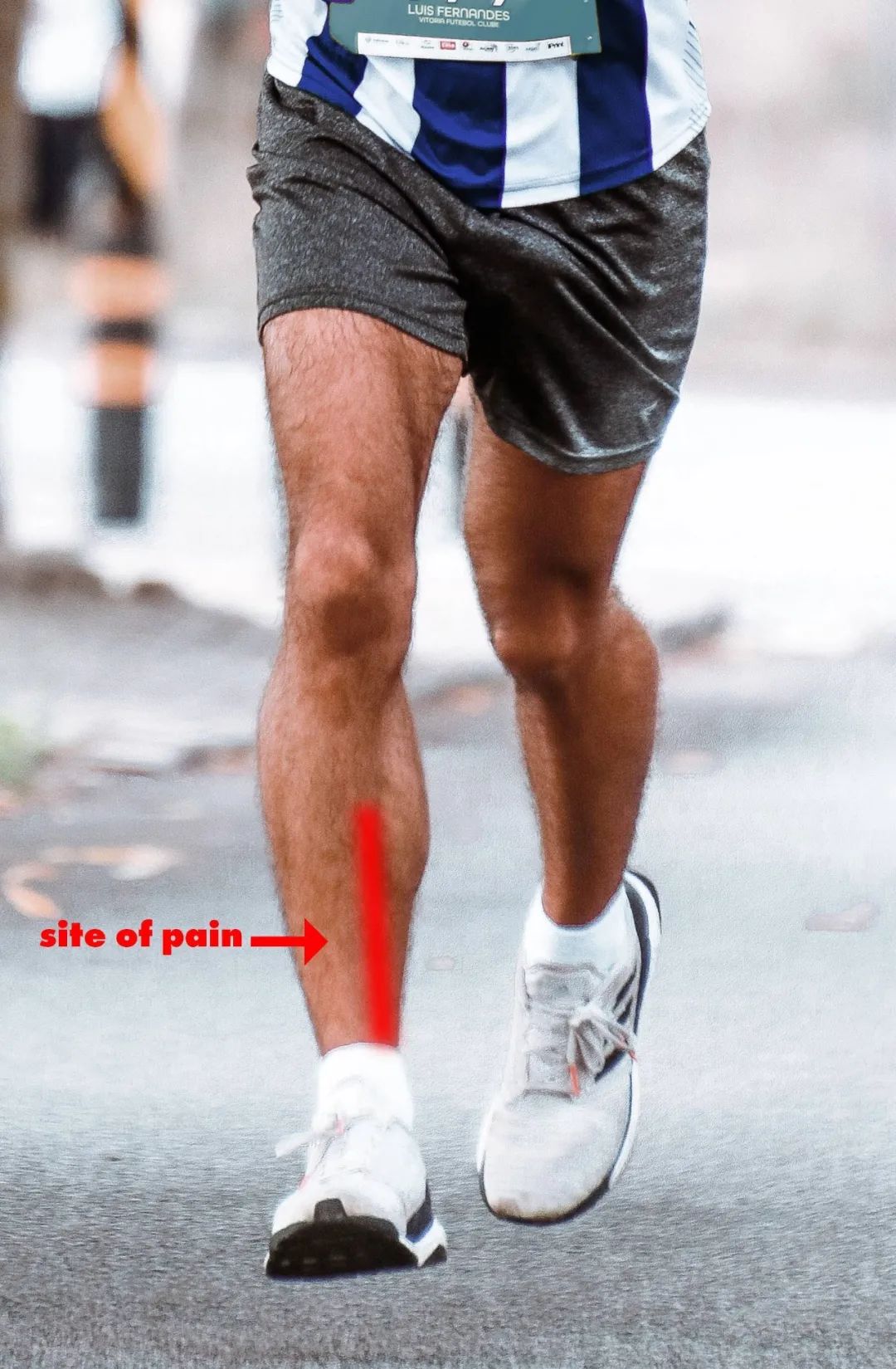 收藏！常见跑步性损伤影像表现总结！