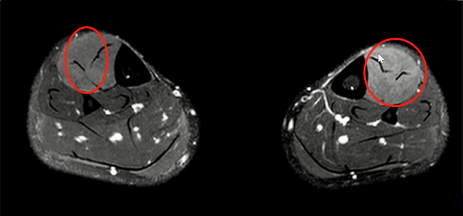 收藏！常见跑步性损伤影像表现总结！