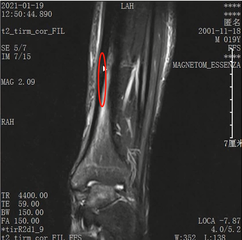 收藏！常见跑步性损伤影像表现总结！