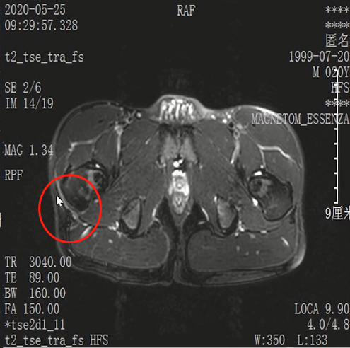 收藏！常见跑步性损伤影像表现总结！