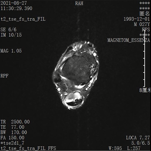 收藏！常见跑步性损伤影像表现总结！