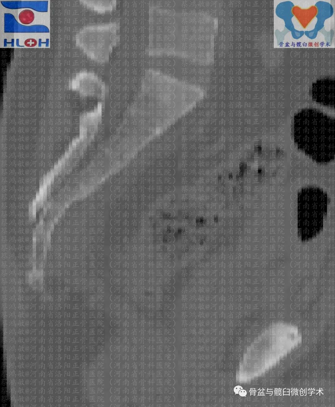 图2-47 骨盆环和骶髂关节(前面观)-骨科临床解剖学-医学