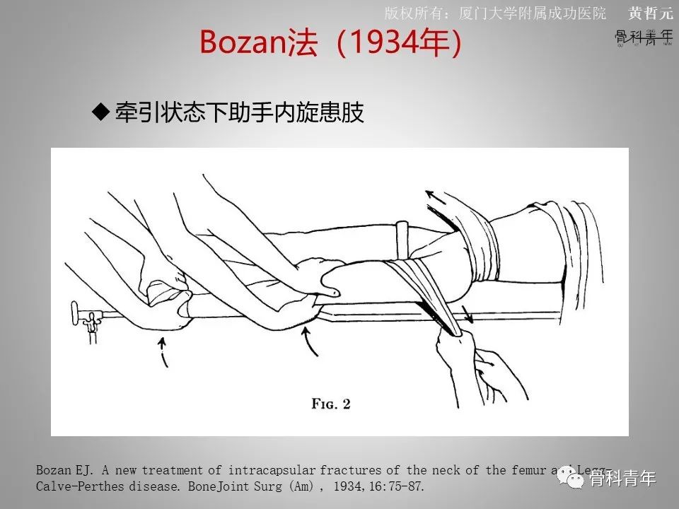 一文掌握股骨颈骨折的分型、复位与内固定！