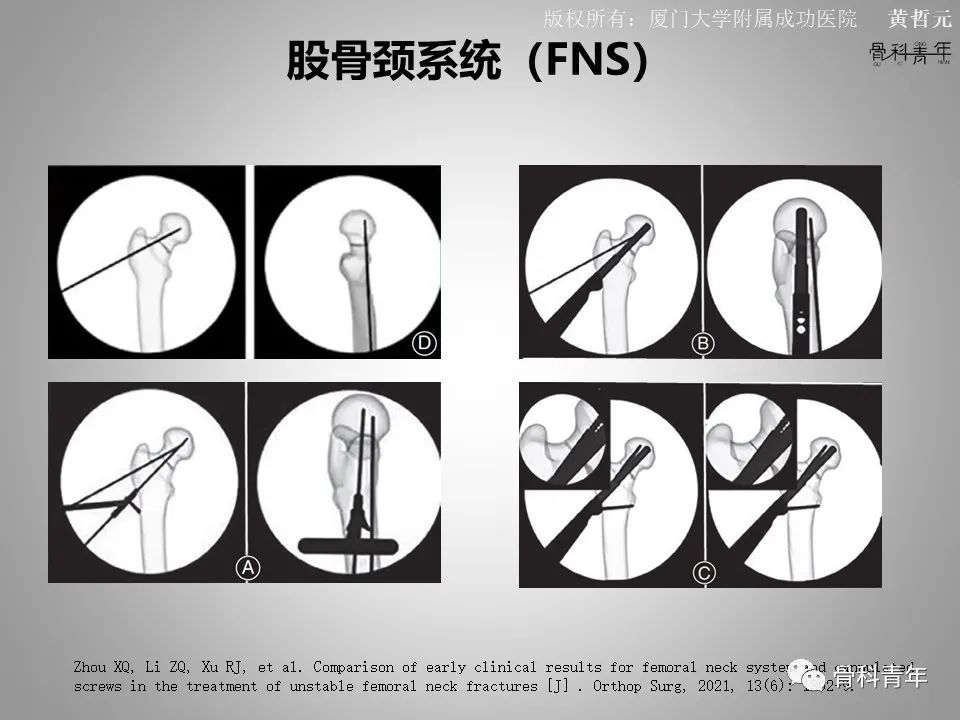 一文掌握股骨颈骨折的分型、复位与内固定！