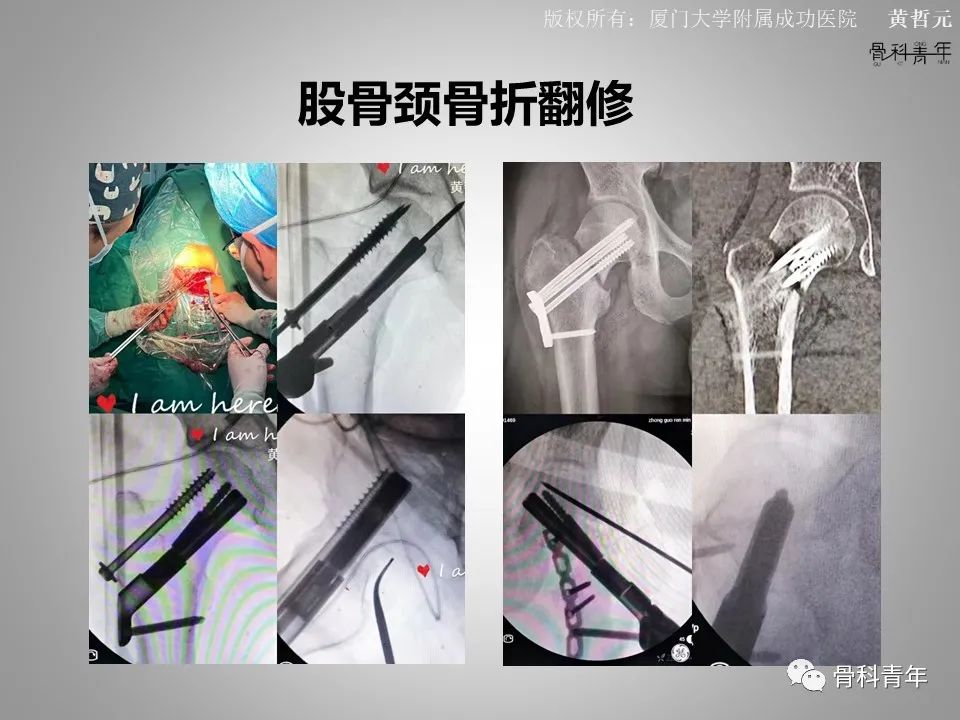 一文掌握股骨颈骨折的分型、复位与内固定！