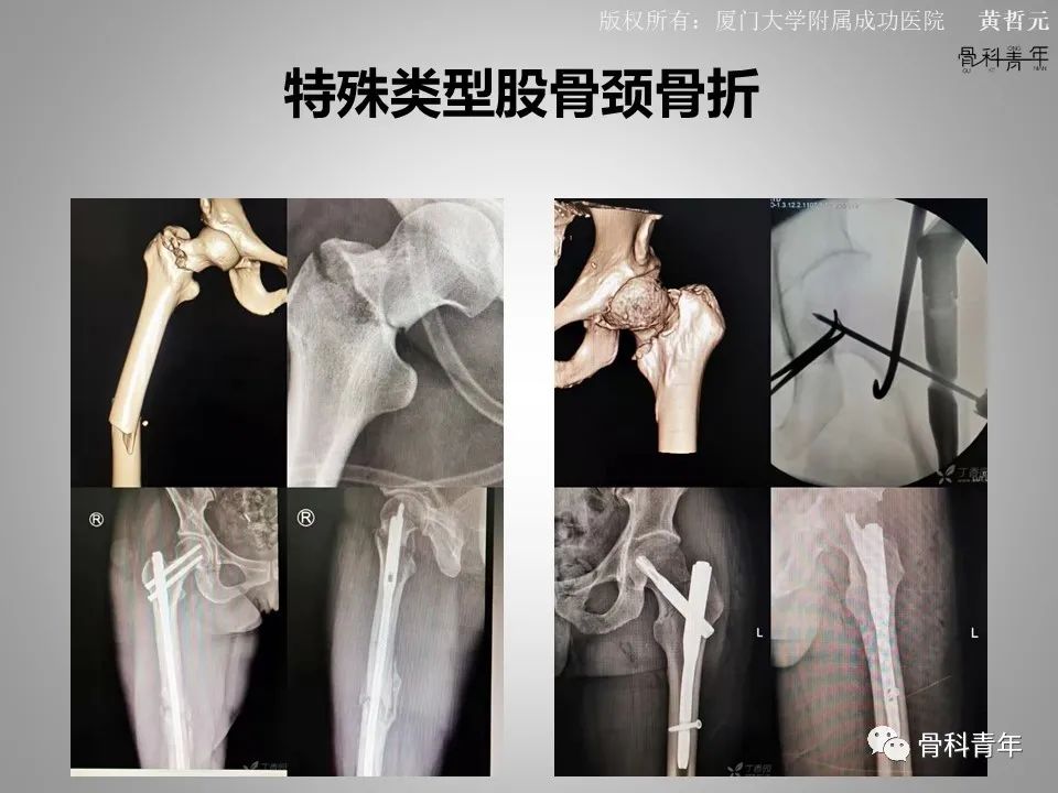 一文掌握股骨颈骨折的分型、复位与内固定！