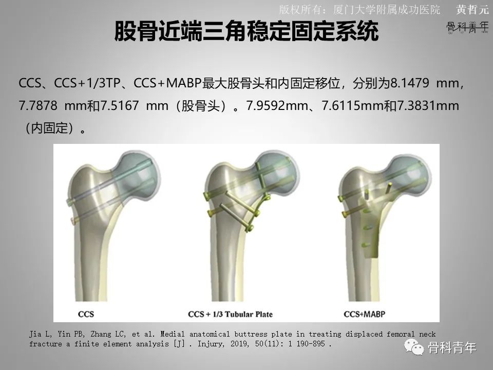 一文掌握股骨颈骨折的分型、复位与内固定！