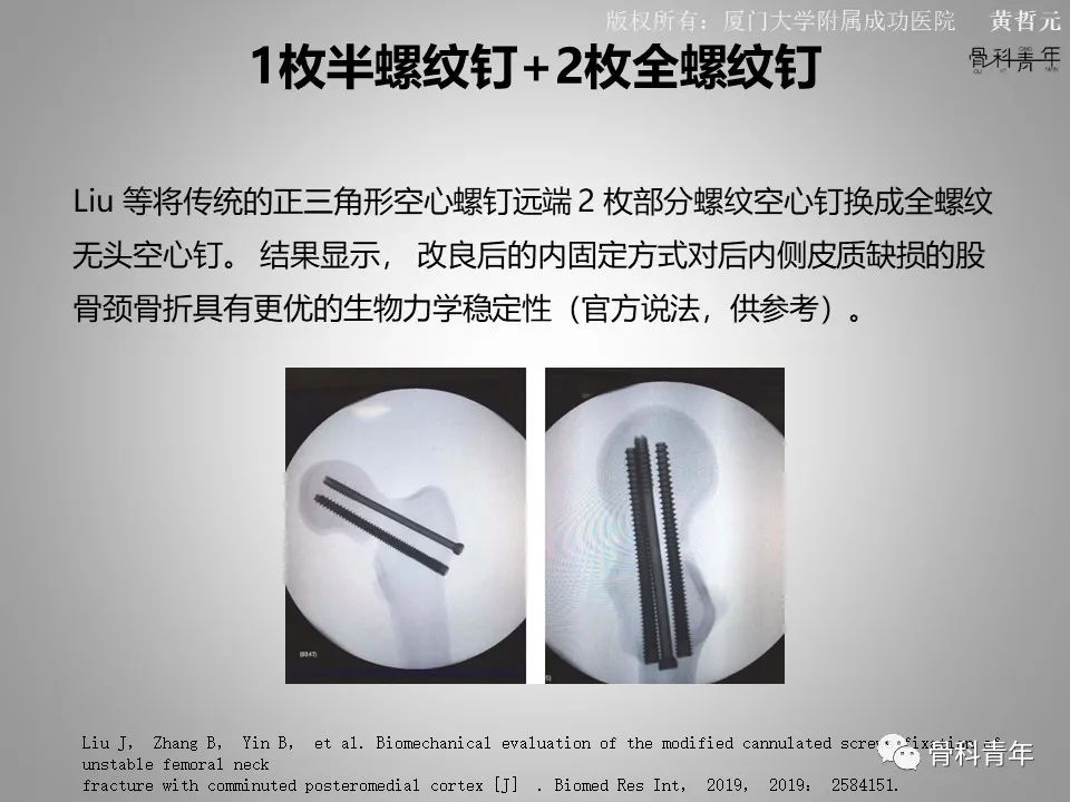 一文掌握股骨颈骨折的分型、复位与内固定！