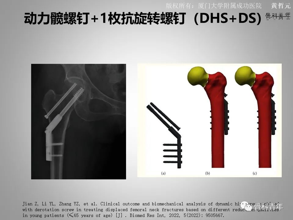一文掌握股骨颈骨折的分型、复位与内固定！