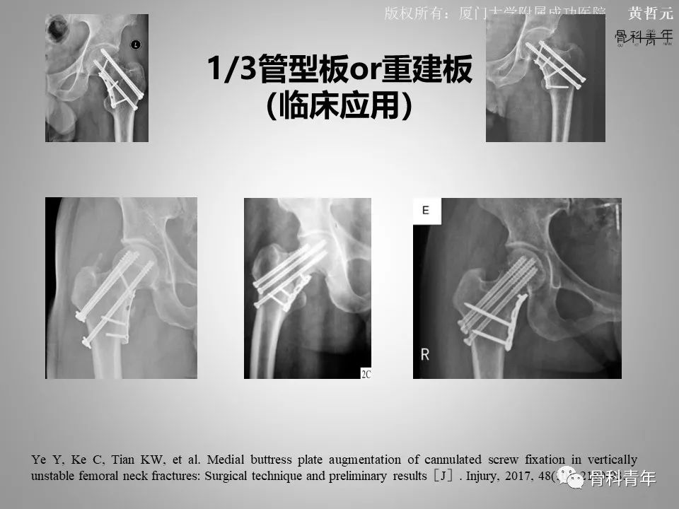 一文掌握股骨颈骨折的分型、复位与内固定！
