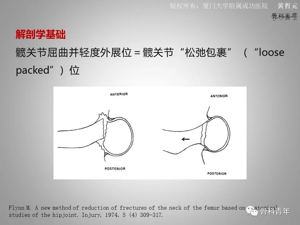 一文掌握股骨颈骨折的分型、复位与内固定！