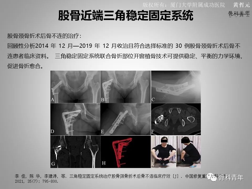 一文掌握股骨颈骨折的分型、复位与内固定！