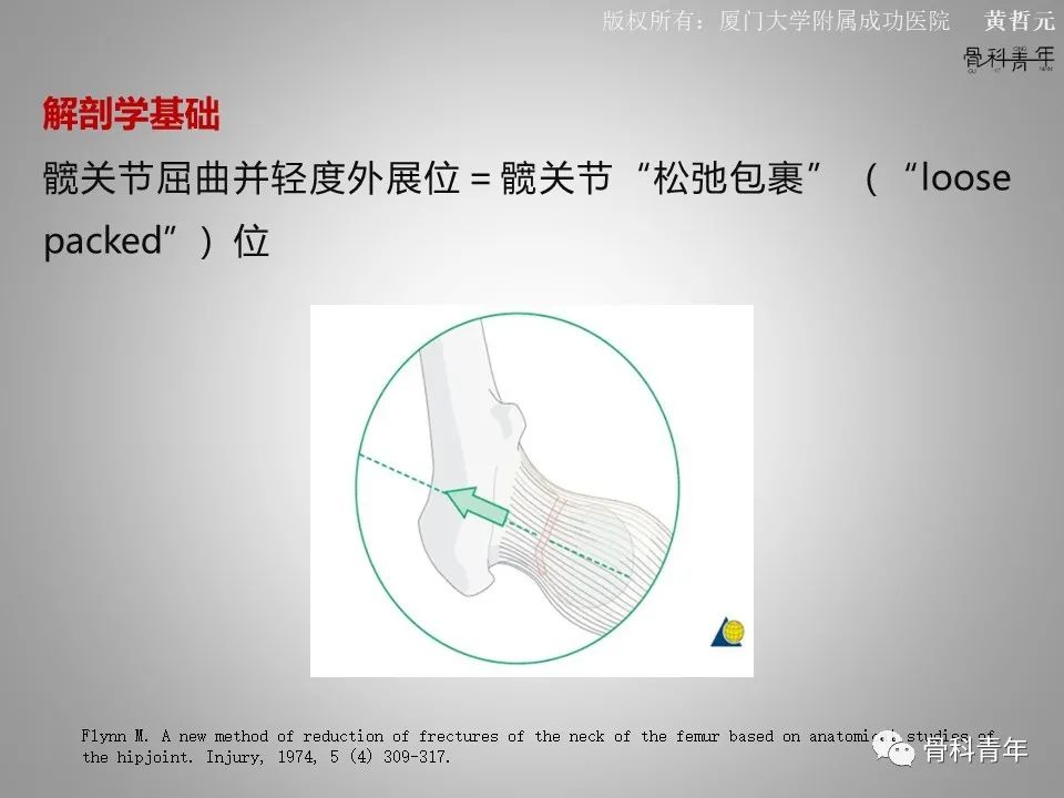 一文掌握股骨颈骨折的分型、复位与内固定！