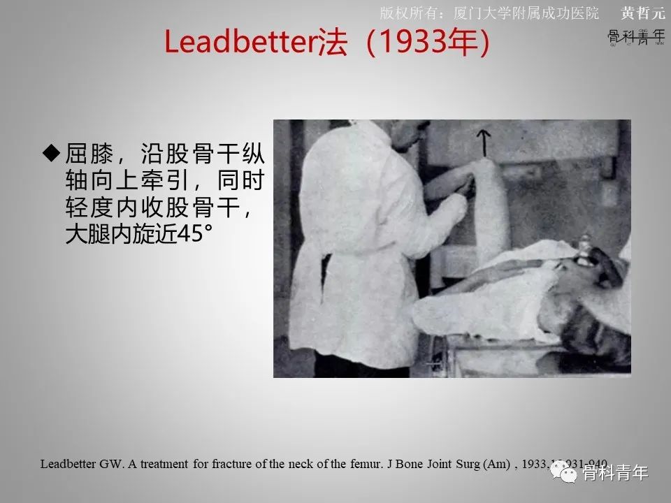 一文掌握股骨颈骨折的分型、复位与内固定！