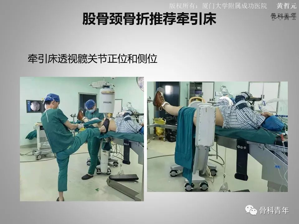 一文掌握股骨颈骨折的分型、复位与内固定！