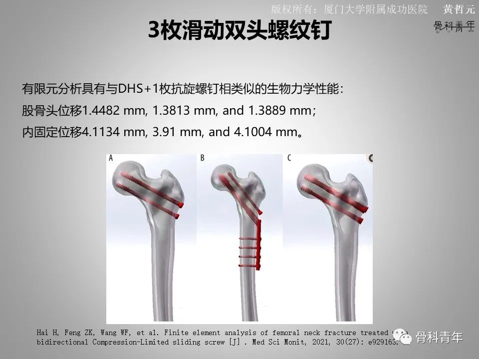 一文掌握股骨颈骨折的分型、复位与内固定！